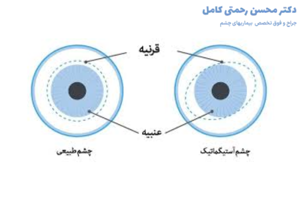 علت بروز آستیگماتیسم چشم