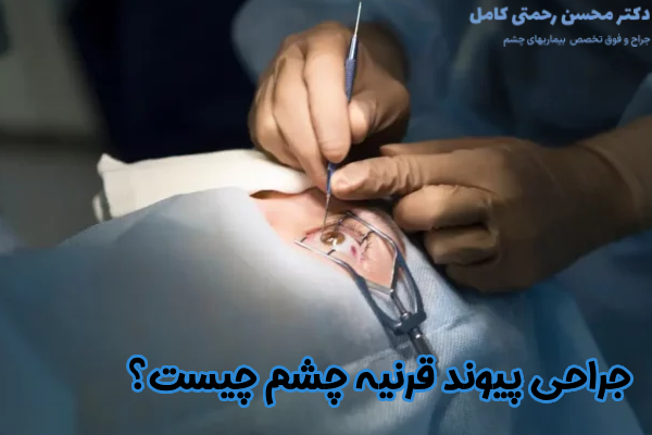 جراحی پیوند قرنیه چشم