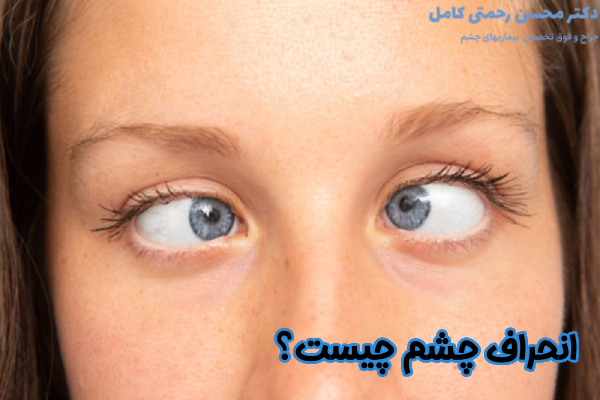 انحراف چشم چیست